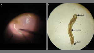 eyeworm-1200x675.jpg